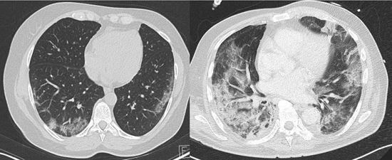ct showing pneumonia caused by Covid-19